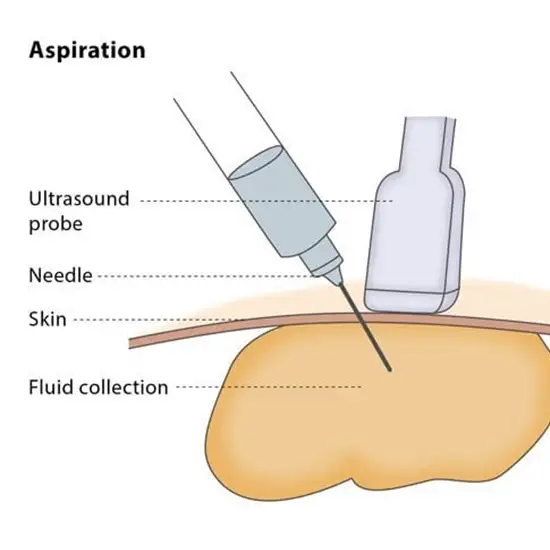 Ultrasound Guided Aspiration